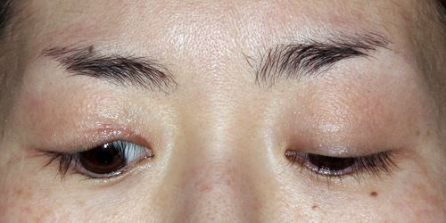 下垂 トレーニング 眼瞼 【50代のお悩み】まぶたが下がる病気「眼瞼下垂」。原因は？対策方法は？専門家が徹底解説！